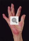 Deformidade nos dedos Causados pelo Lupus